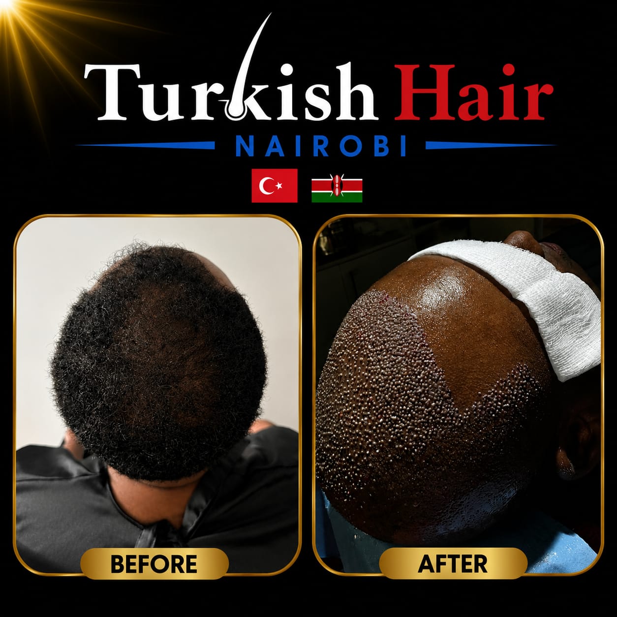 Turkish Hair Nairobi Case 6